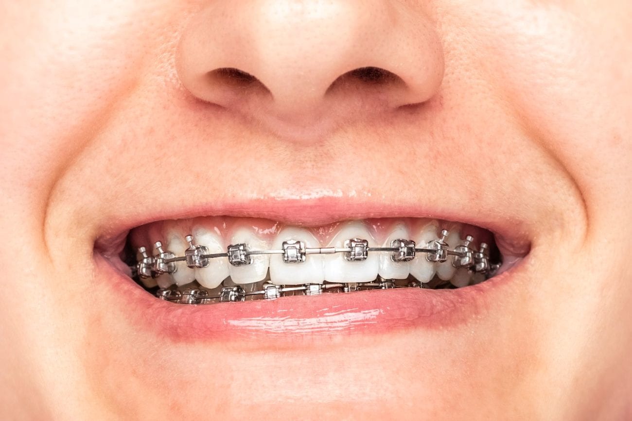 您需要了解的關於箍牙治療的知識