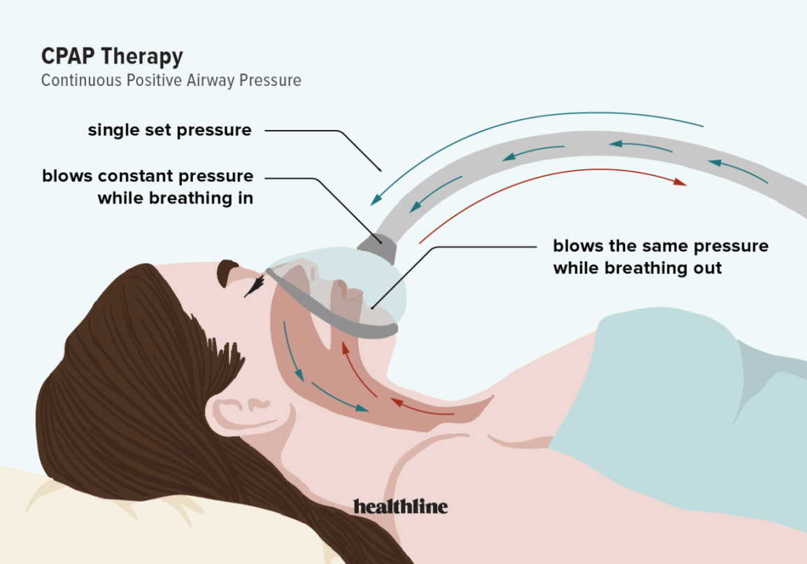 睡眠呼吸暫停治療 – CPAP